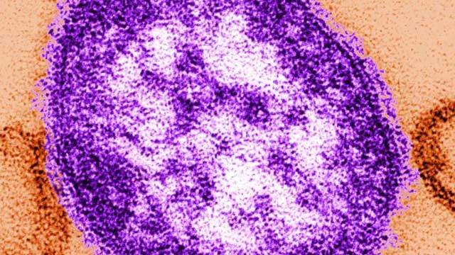 Measles-jpg