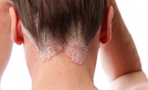 Psoriasis Severity is Linked to High Blood Pressure Risk