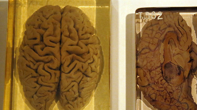 Missing brains mistery solved by University of Texas1