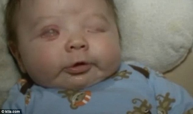 baby born without eyeballs