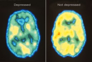 depression to brain inflammation