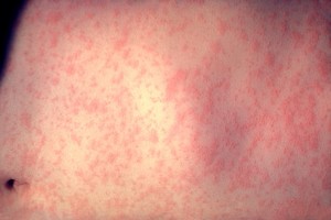 new cases of measles