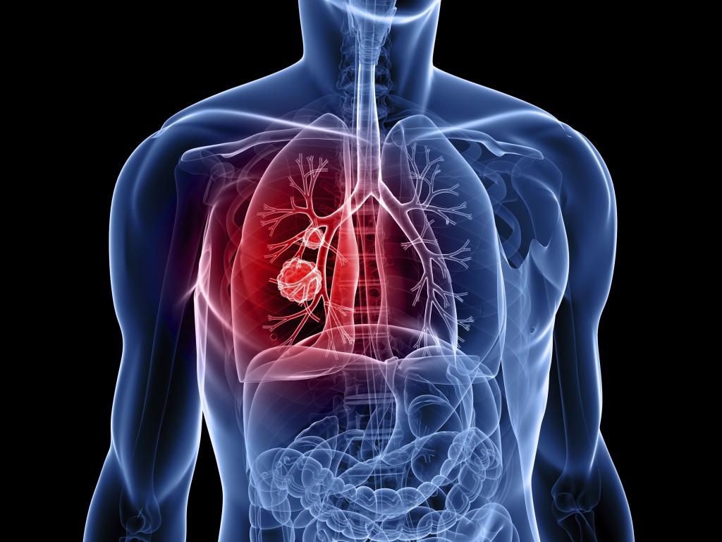 Medicare to Pay for Smokers’ Lung Cancer Annual Screening