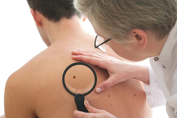 alt="dermatologist examines a mole of male patient"