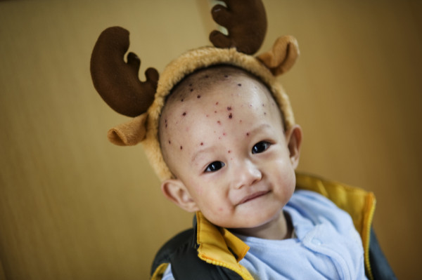the cases of chickenpox continuously decreased