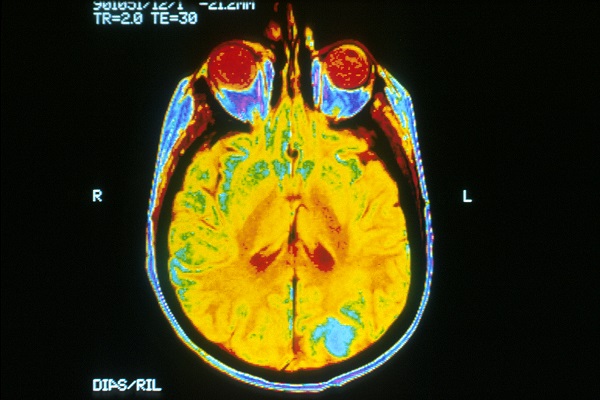 Brain magnetic resonance imaging