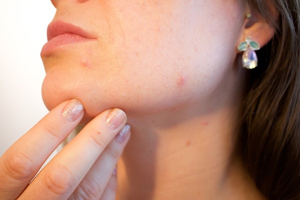 Woman showing her mild acne